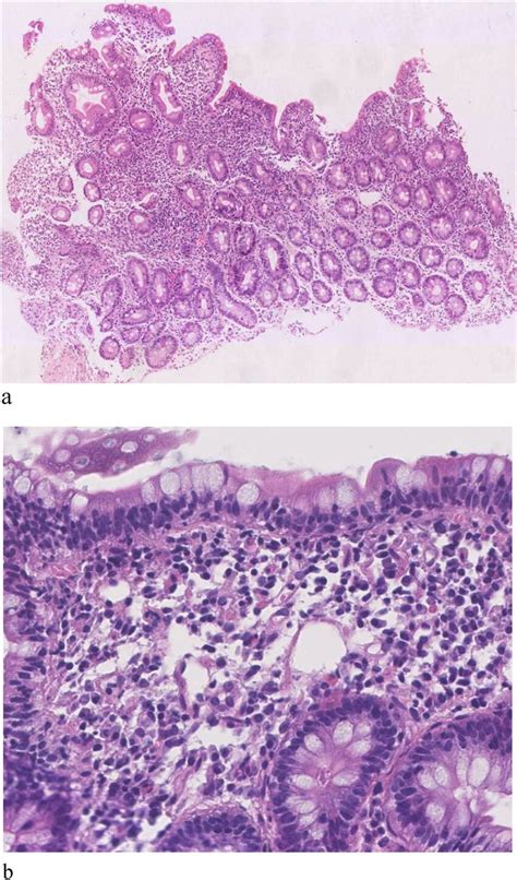 Histopathological Findings In Mucosal Biopsies A Chronic