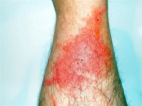 Poison Ivy Rash Stock Photo Image Of Breakout Eczema 46073550