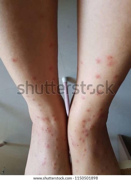 Human Skin Rash From Cats