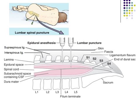 Anatomy For Lumbar Puncture
