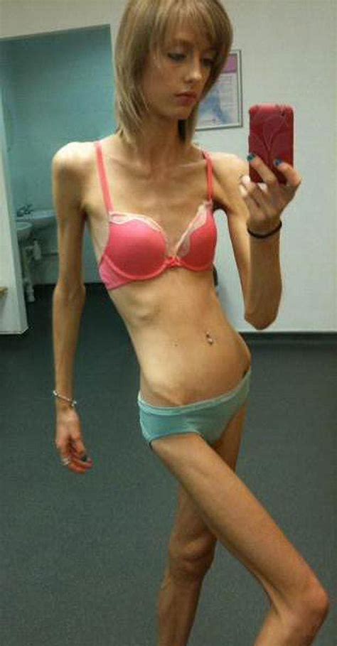 Anorexic Woman Wearing Bikini Photo Xxx Sex Photos Comments