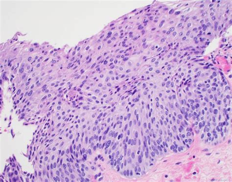 High Grade Squamous Intraepithelial Lesion Archives Atlas Of Pathology