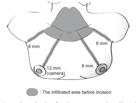 Figure 1 From The Benefits Of Preincision Ropivacaine Infiltration For