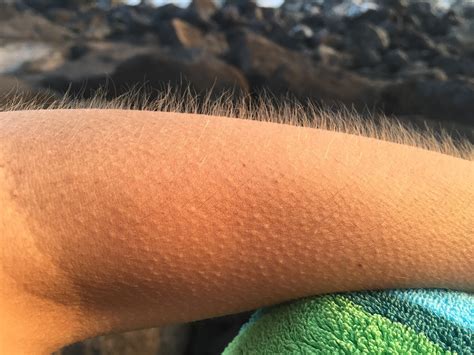 Why Do We Get Goosebumps How It Works