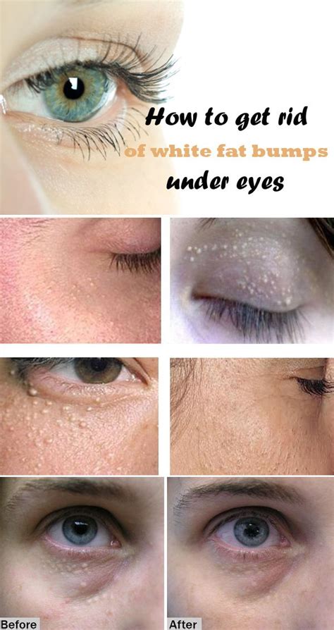 How To Get Rid Of White Fat Bumps Under Eyes Milia