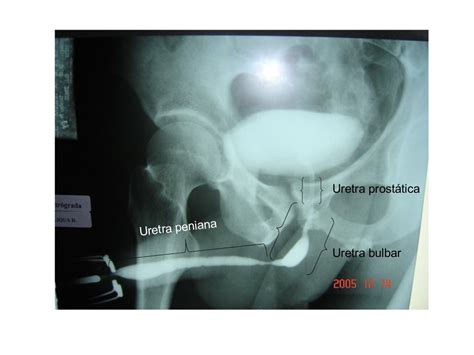Radiologianota10 Uretrocistografia Retrógrada E Miccional