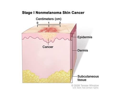 Stage I Nonmelanoma Skin Cancer Drawing Shows A Tumor In The Epidermis