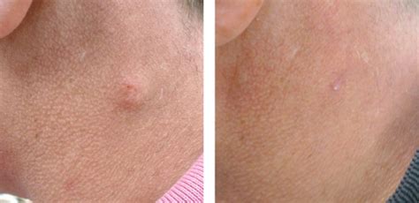 Skin Facial Arm Sebaceous Cheap Cyst Removal London Uk