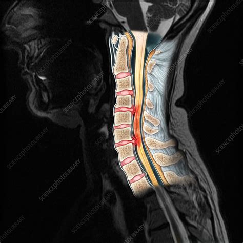 Cervical Spine Injury Mri Illustration Stock Image C0277458