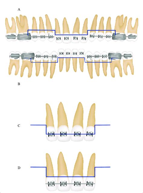 Llustration Of The Straight Wire Intrusion System A Maxillary