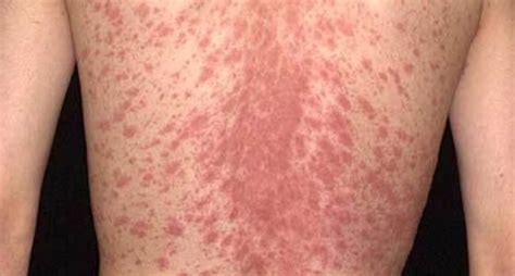 Pityriasis Rosea Skin Rash By Cnri Science Photo Library Lupon Gov Ph