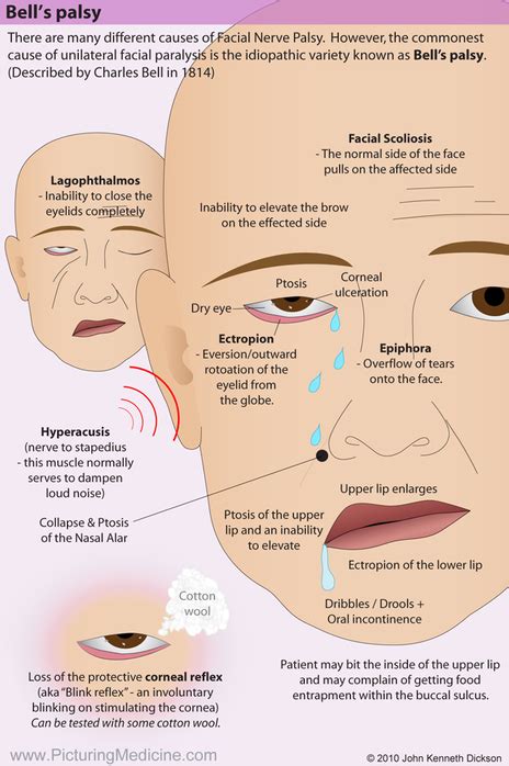 Bell S Palsy There Are Many Different Causes Of Facial Grepmed