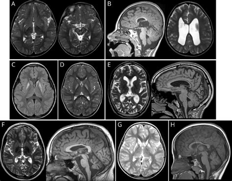 Specific Brain Mri Findings Of 8 Patients Download Scientific Diagram