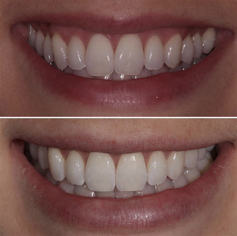 How Dangerous Is Teeth Shaving Bespoke Smile