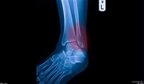 Lateral Malleolus Fracture Anatomy Diagnosis And Treatment Center
