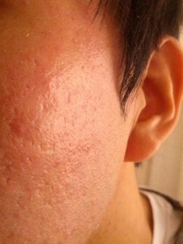 Need Recommendation For Acne Scarorange Peel Texture Pics Included