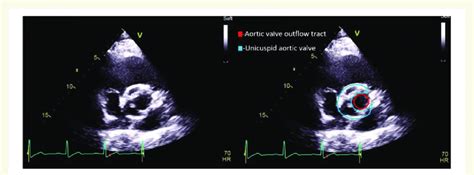 Transthoracic Echocardiogram Parasternal Short Axis View Demonstrating