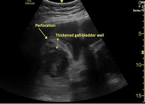 Case 32 Perforated Gallbladder Ucsd Ultrasound