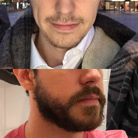 The results have been slow but i'm trusting the process and going strong. Minoxidil Guide for Thicker Beard, Facial Hair and Fuller ...