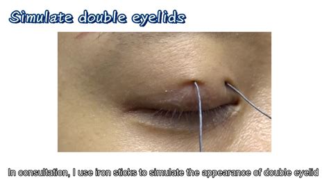 Lih Ren Clinic Suture Double Eyelid Operation Youtube