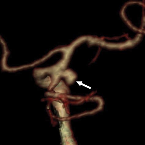 Dual Energy Ct Angiography In The Evaluation Of Intracranial Aneurysms Image Quality Radiation