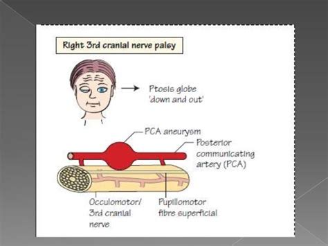 3rd Cranial Nerve Palsy