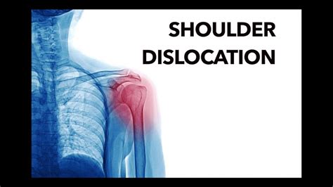 Shoulder Dislocation Physical Therapy In Motion Oc Physical Therapy