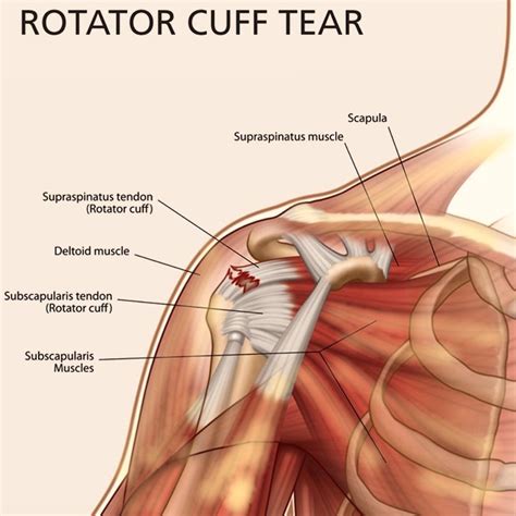 Maybe you would like to learn more about one of these? Full thickness Rotator cuff tear:If its not been repair ...