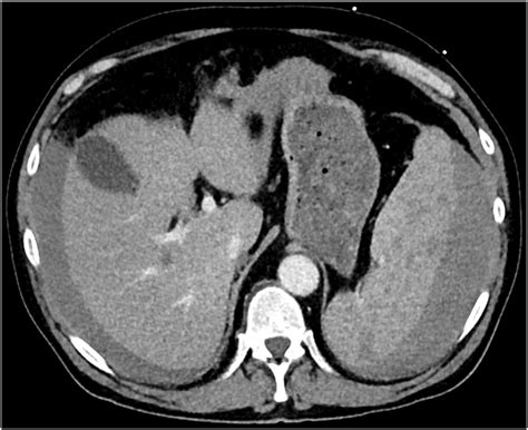 Contrast Enhanced Axial Abdominal Computed Tomography Showing Free