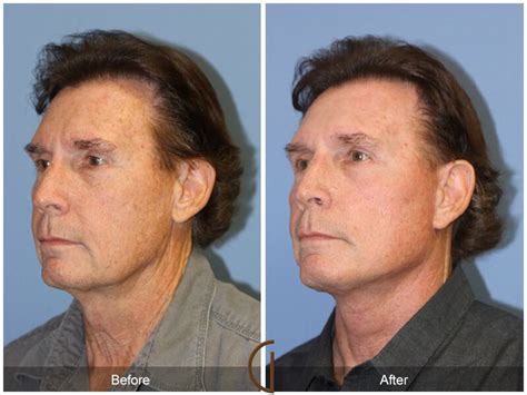 Neck Lift Before And After Photos Patient 20 Dr Kevin Sadati