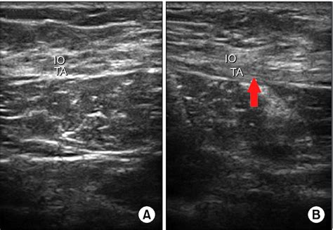 Ultrasonography Of Lower Abdominal Muscle A Left Side Normal B