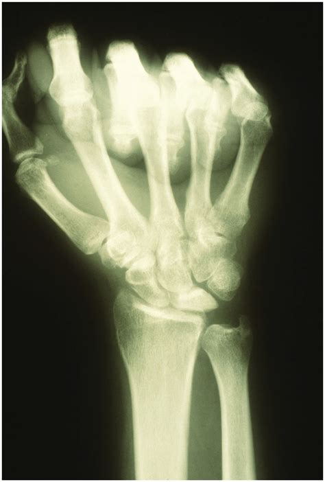 Posteroanterior PA Radiograph Of The Right Wrist Lunate Sclerosis Download Scientific