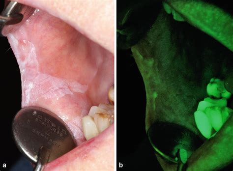 Oral Mucosal Malignancies Springerlink