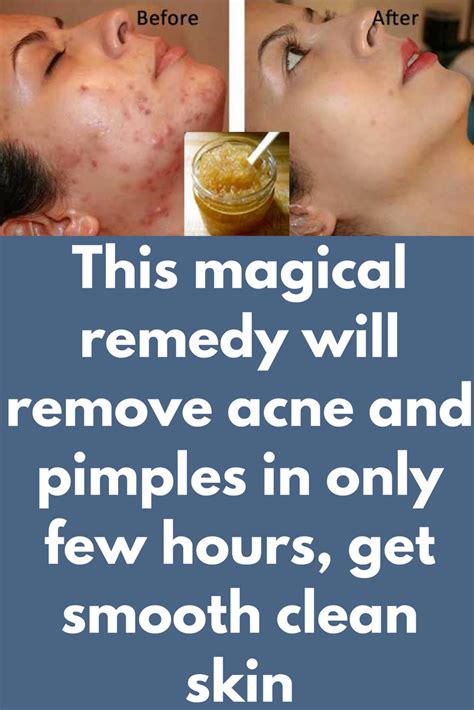 This Magical Remedy Will Remove Acne And Pimples In Only Few Hours Get