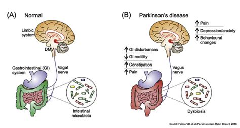 Parkinsons Disease Could Originate In The Gut Study Suggests