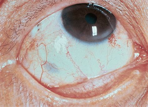 External Segment Of The Eye Conjunctiva Sclera Eyelid Ento Key