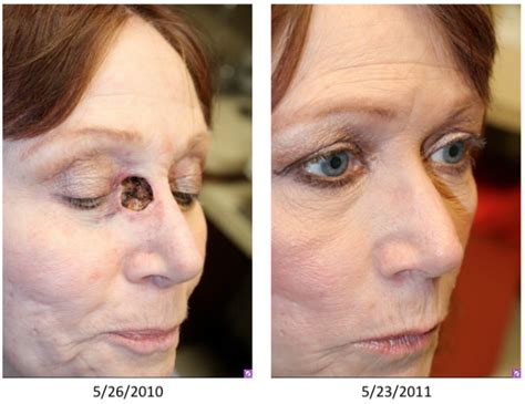 Paramedian Forehead Flap Before And After