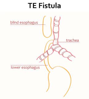 Tracheoesophageal Fistula Embryology Medbullets Step