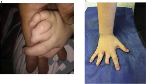 Routine Circumcision The Role Of Prepuce In Syndactyly Repair Journal Of Pediatric Urology