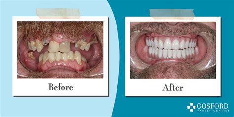 All On 4 Implant Supported Dentures A Dental Case Study