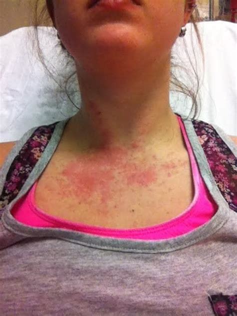 Photos Of Severe Allergic Reactions Best Allergy Sites
