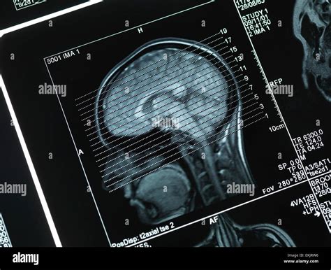 Brain Scan Diagnosis Diagnostics Healthcare Magnetic Resonance