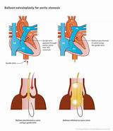 Images of Aortic Stenosis Treatment Options