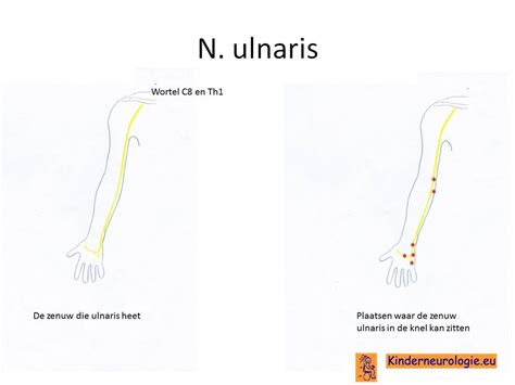 Apr 24, 2017 · an can affect many organs and cause an array of symptoms. Neuropathie: Entrapment Neuropathie N Radialis