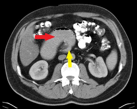 Abdo Pelvic Ct Scan With Iv And Po Contrast Showing A Dilated Duodenal