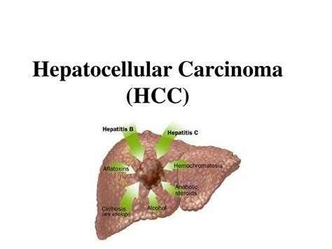 Ppt Hepatocellular Carcinoma Hcc Powerpoint Presentation Free