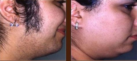 Yes, men are also increasingly opting for laser hair removal for their facial hair, but perhaps not for the exact same results as women. Laser Hair Removal - Before/ After Images. Facial Hair ...
