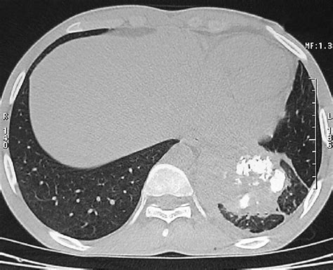 Ct Of The Thorax Lung Window Showing A Left Lower Lobe Lobulated Mass