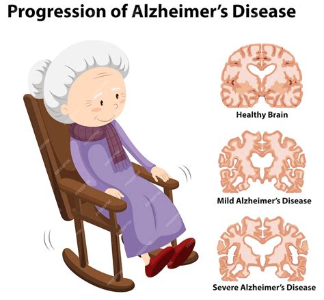 Premium Vector Progression Of Alzheimer S Disease