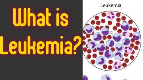 Leukemia Types And Classifications Youtube